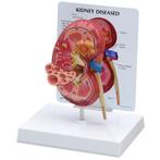 Anatomisch model niercyste ST-ATM 87, Verzenden, Nieuw