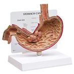 Anatomisch maagmodel pathologie ST-ATM 78, Verzenden, Nieuw
